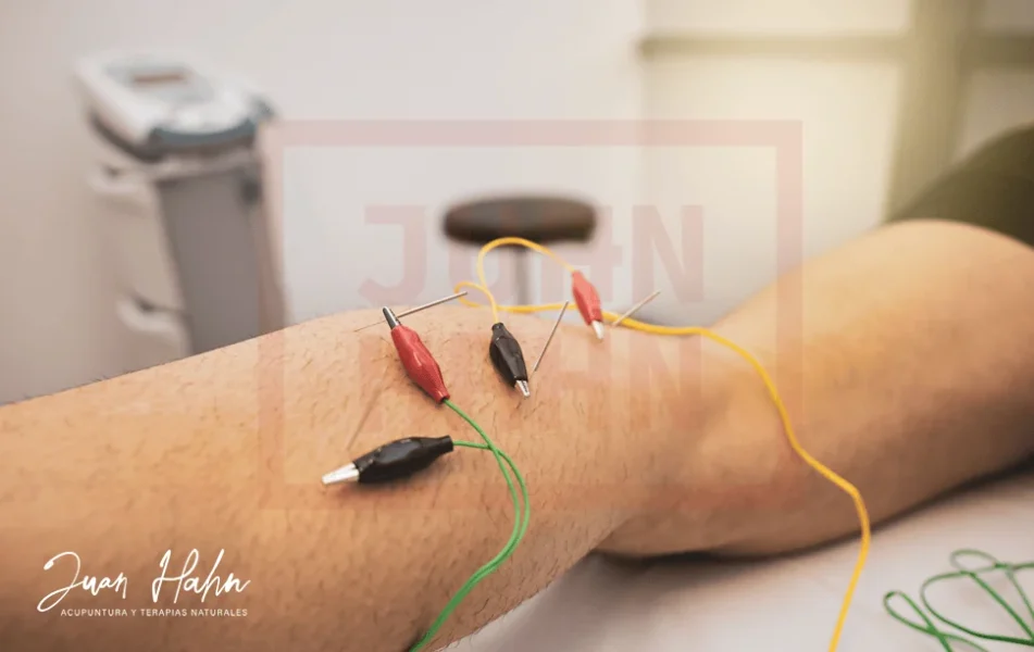 Electroacupuntura - Curso Online - Imagen 06