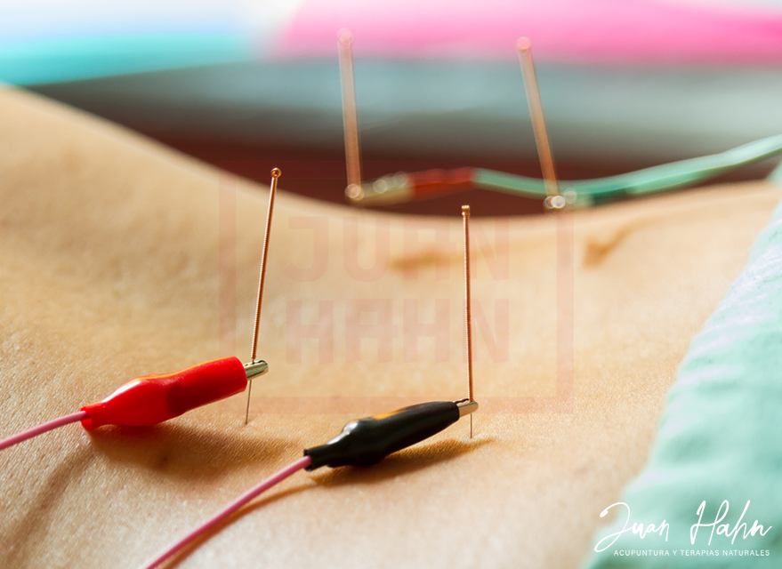 Electroacupuntura - Curso Online - Imagen 08